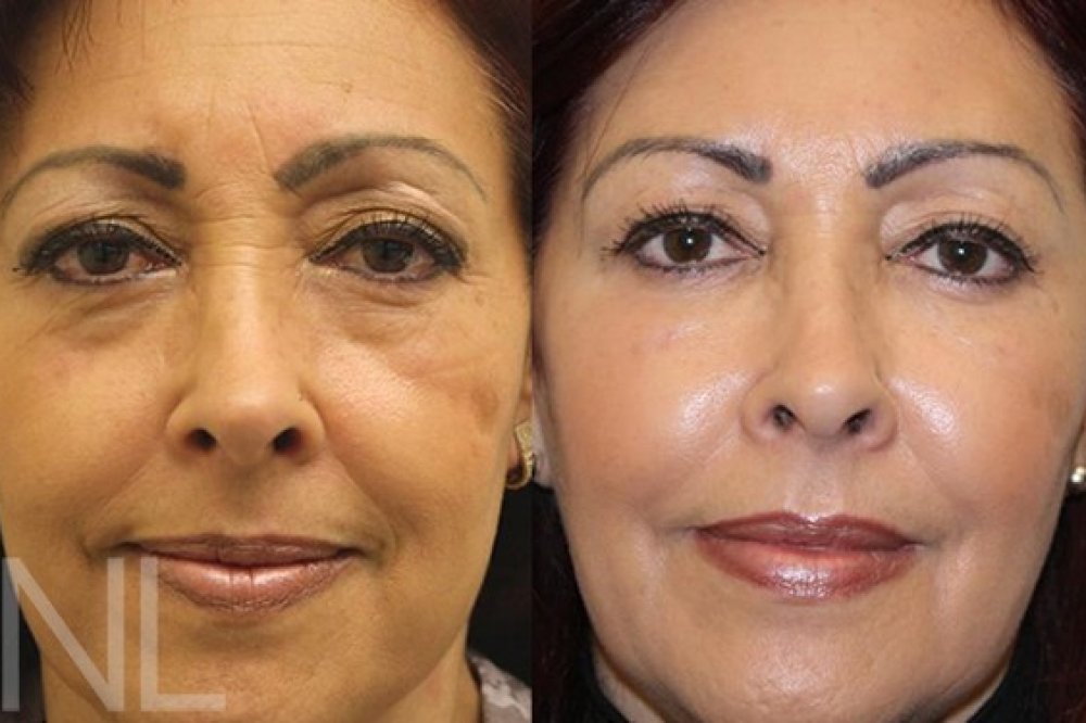 Sculptra® | SCULPTRA® | FALTENCLINIC